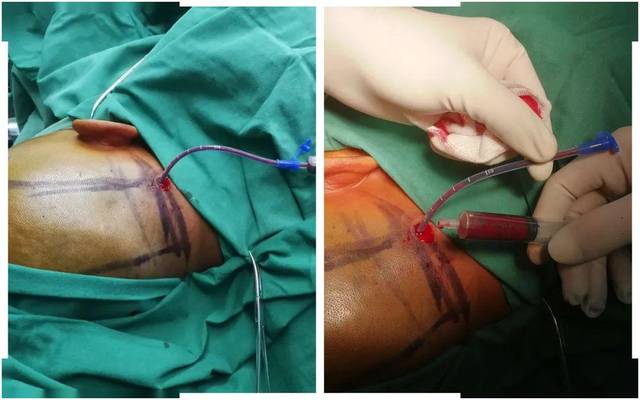 术中穿刺成功并抽出部分陈旧性血肿8ml及血性脑脊液5ml