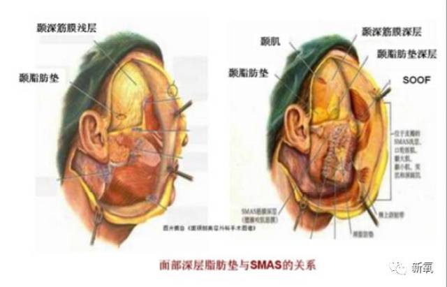 脂肪垫互相影响,也就意味着眼周无论是眼轮匝肌还是soof的老化松弛