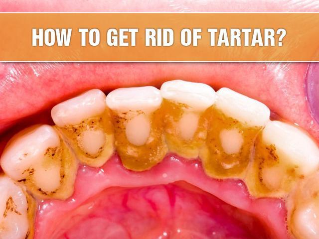 牙齿内侧黄黄的牙垢怎么清除?