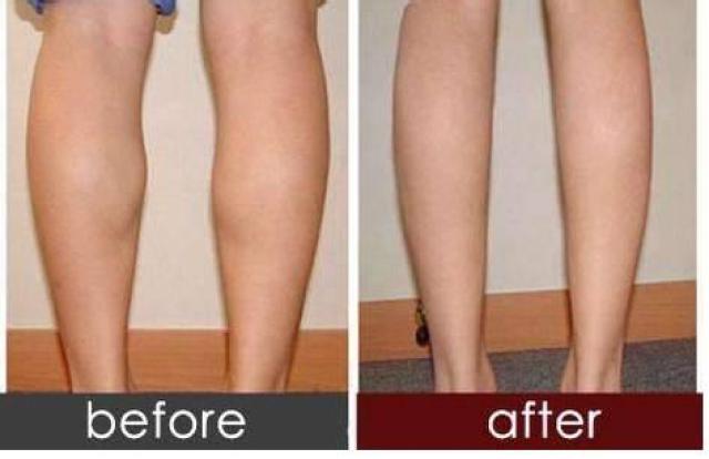 所以啵妹今天就来推送一波瘦腿针 瘦腿针效果图