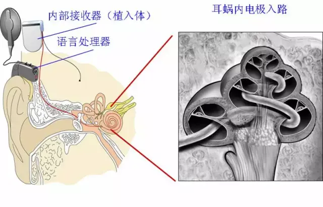 【超詳細】人工耳蝸簡介--龍灣惠耳助聽器