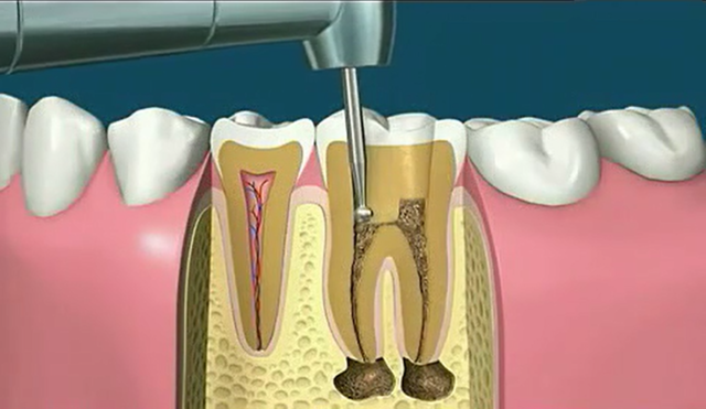 根尖周炎的治疗方法图片