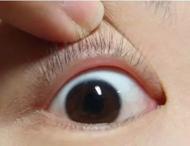 请看这只眼睛,红色的带血丝的部分是眼睑,眼睑上面睫毛根部生长