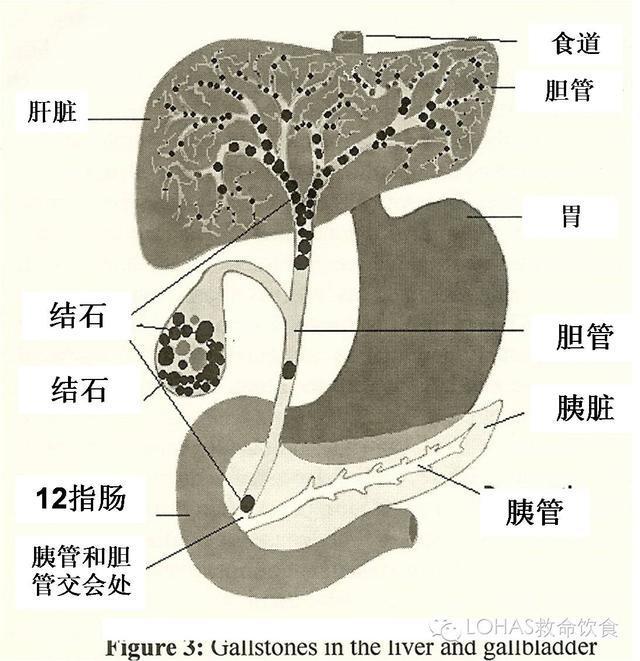 肝内胆管结石位置图片