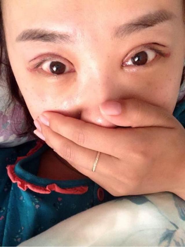割双眼皮 内吸眼袋,分享我的双眼皮恢复过程
