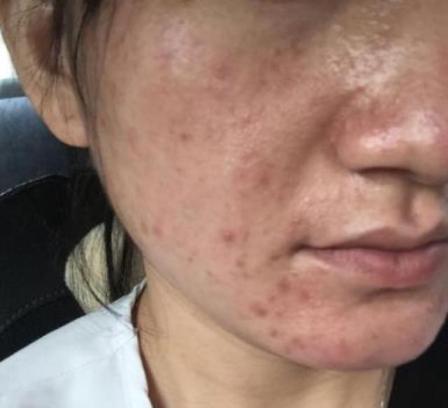 使用激素产品会让脸变黑