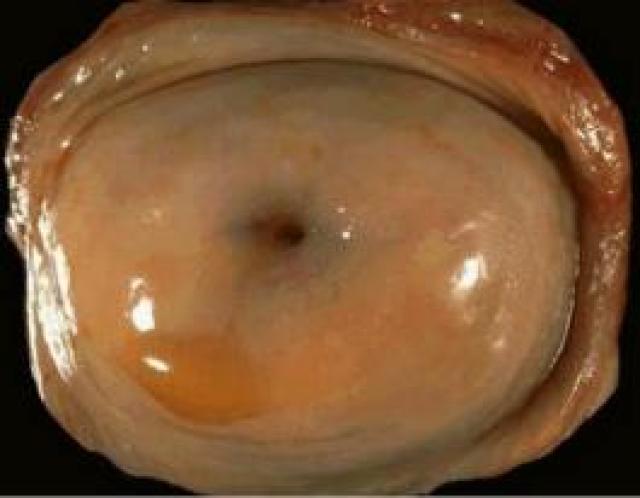 宫颈白斑 宫颈白斑指在子宫颈阴道部出现的一种灰白色不透明的斑块状