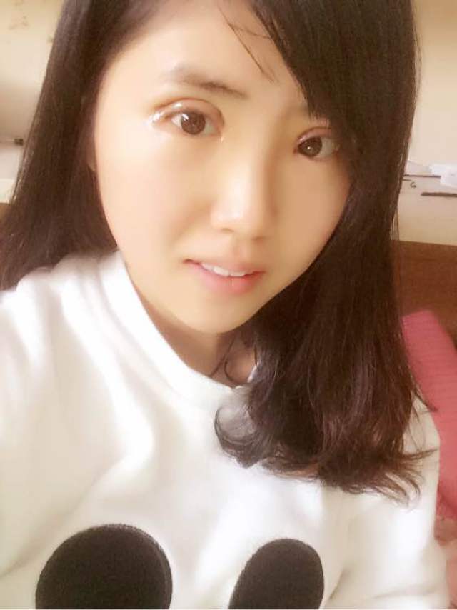 全切双眼皮 去皮去脂,做的是平行的,怎么样