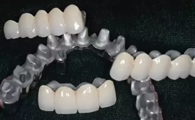 金属冠桥时,则优先考虑贵金属(金合金,金铂合金等),其次是纯钛金属,再