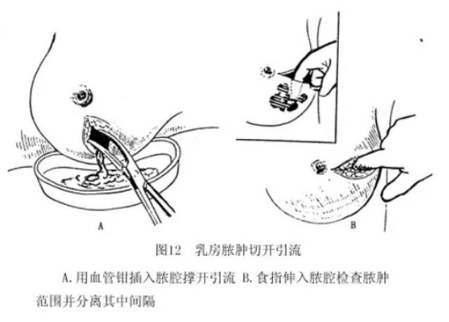 如果是无菌性的,能及时有效移出乳汁,并对局部乳房进行冷敷,往往体温