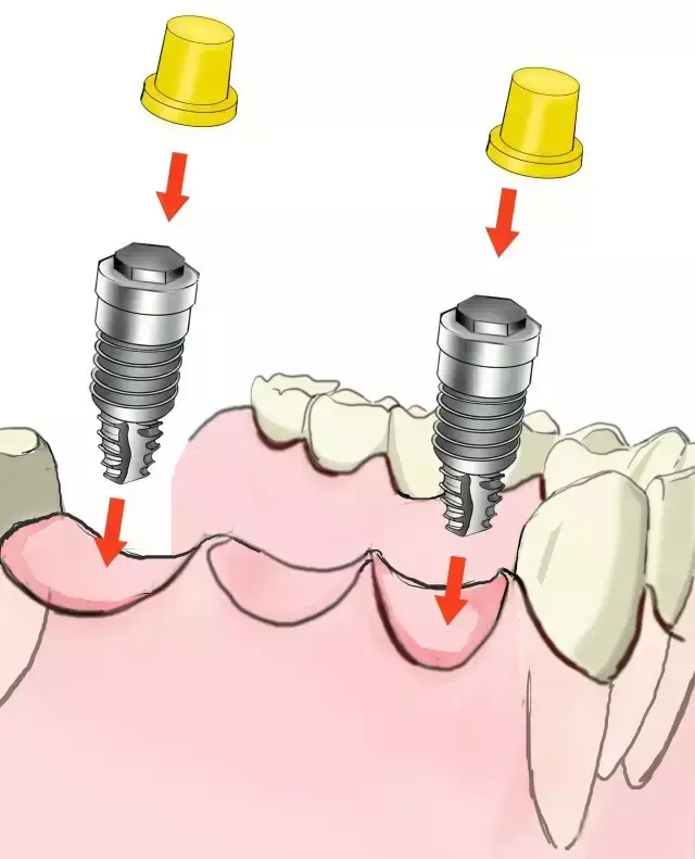 让您真正了解传统镶牙和种植牙的区别