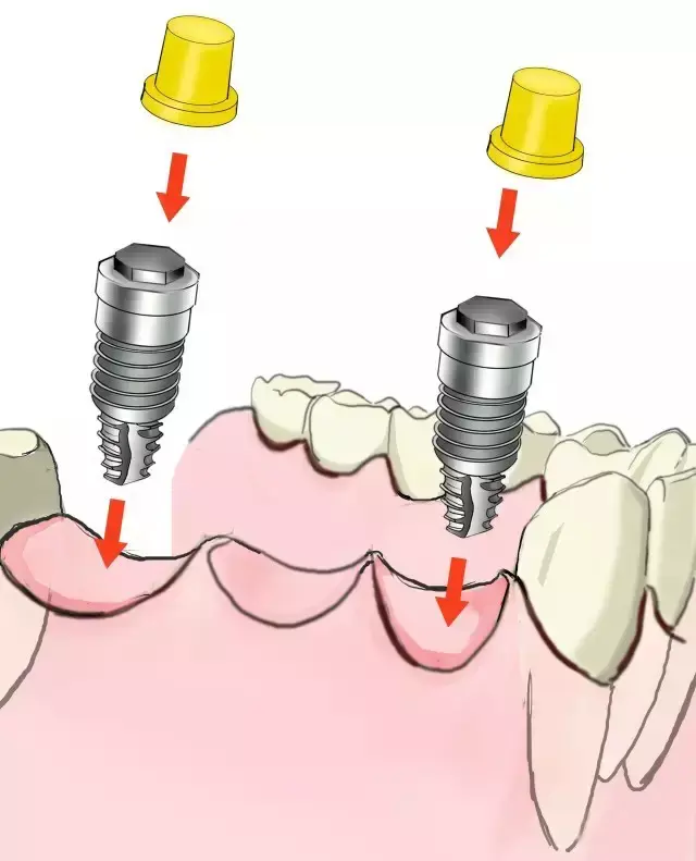 在两边的牙槽窝植入种植钉