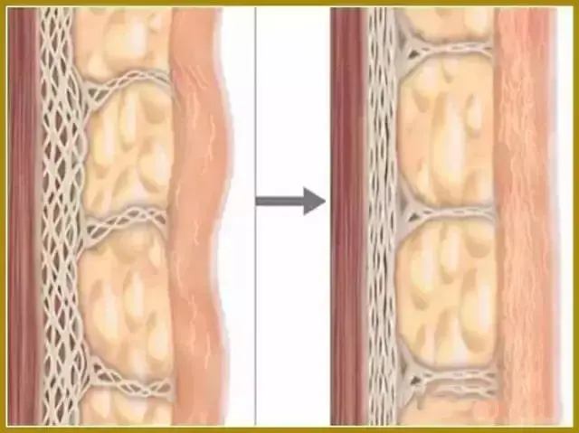 2,真皮:胶原蛋白,透明质酸流失,真皮变薄 3,浅层脂肪(各种脂肪垫)