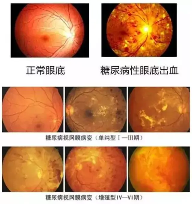 糖尿病患者病变后的视网膜
