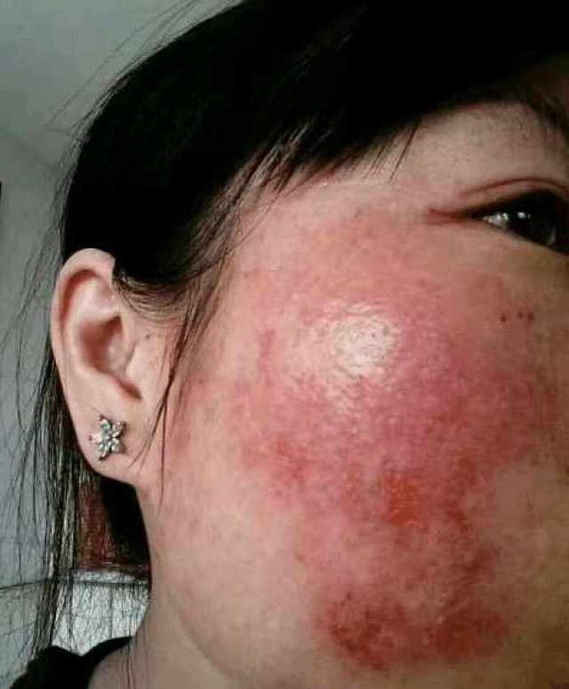 激素脸的治疗方法:激素对皮肤的伤害有多大?