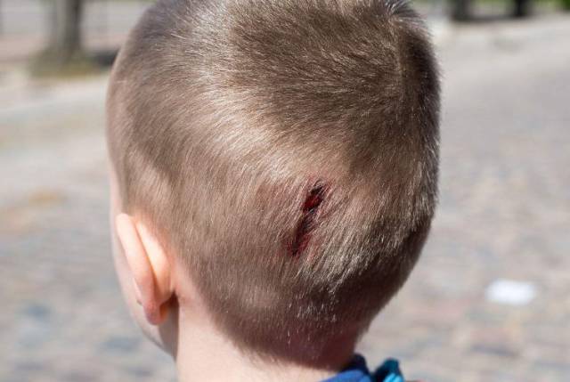不论大人或孩子头皮出现包块时,不要随便揉搓,否则可能导致头皮血肿