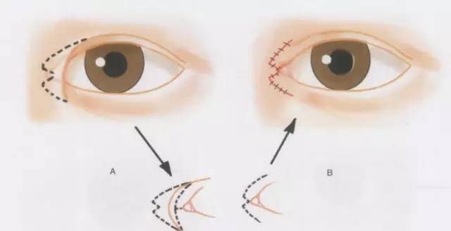 所以呢,我们的开内眼角, 就是将这块内眦赘皮 通过手术的方式切缝消除