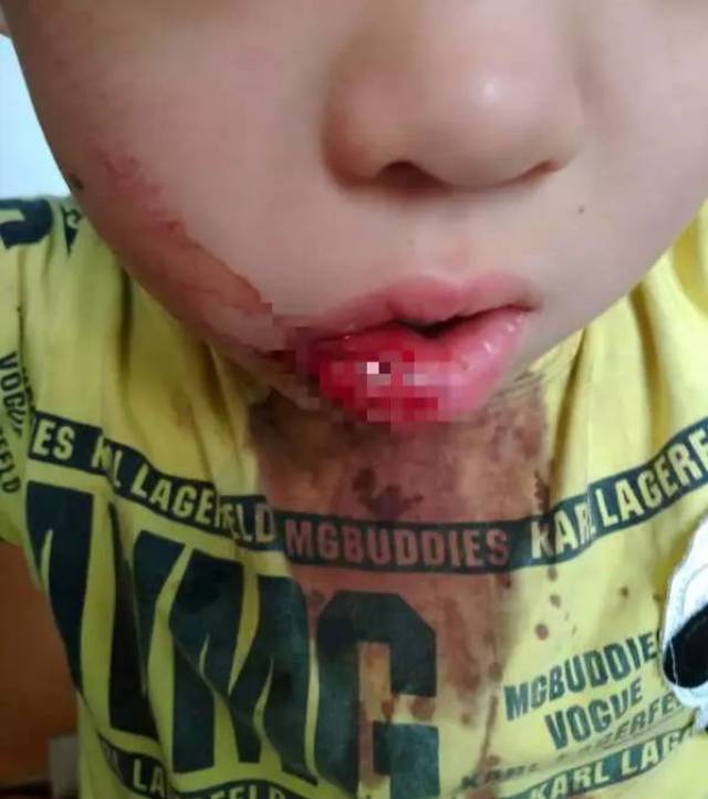 小孩子嘴巴流血图片图片