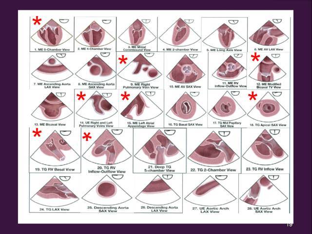 答:经胸超声时选心尖部四腔心切面为宜;经食道超声双静脉平面,探头往
