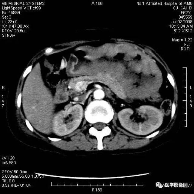 見多個淋巴結腫大 圖6-6-4 浸潤型胃癌 ct平掃見小彎側胃壁不規則增厚