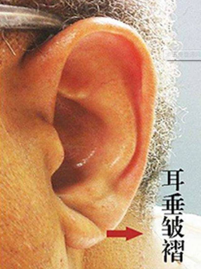 耳垂卷曲面相图片