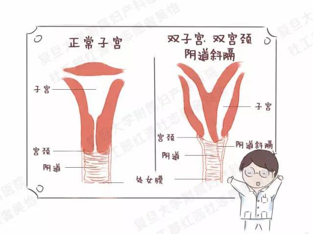一般来说,每一位女性只有一个阴道,一个子宫,宫颈像一扇门连通于阴道