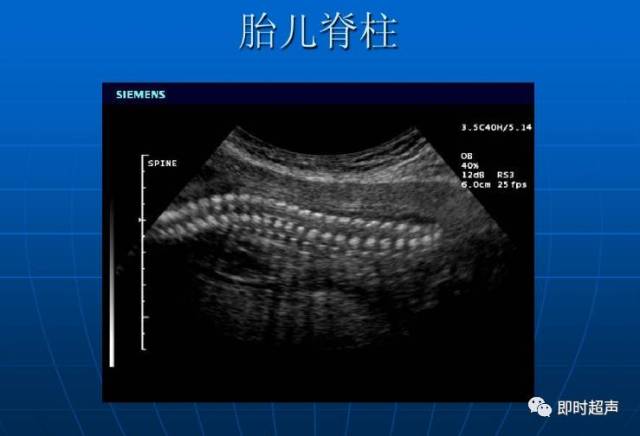 正常中晚期妊娠胎儿超声解剖