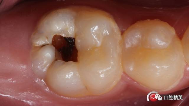 牙齿龋坏六中洞型图片图片