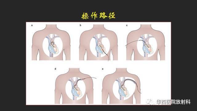 主要通过介入的方式治疗老年性退行性三叶主动脉膜狭窄(as)的微创手术