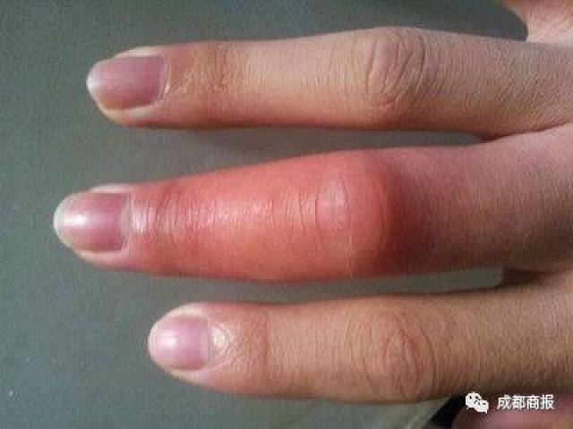 此外,肿胀明显者可抬高被蜇伤部位的肢体,受伤24～48小时内局部冰敷.