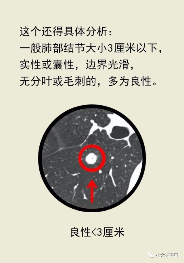 肺部体检时发现了小结节,要怎么办?