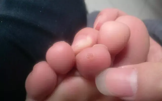 鸡眼为豌豆大小淡黄色角质增生,呈圆形,表面光滑,与皮肤表面持平或略