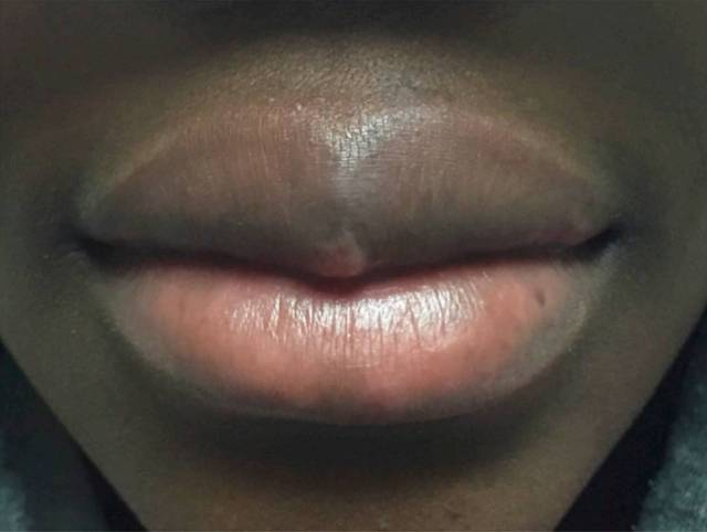 有奖病例竞猜 第110期丨嘴唇增厚,舌尖丘疹,奇怪症状的病因为何?