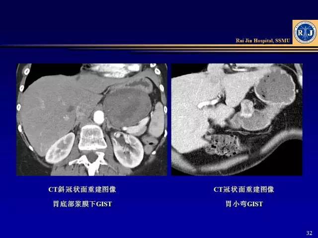 腹部ct胃癌图,胃t图片,胃胃镜图_大山谷图库